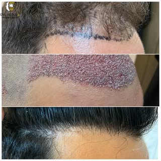 Reconstrucción de Línea Frontal. Microinjerto Capilar. Antes y Después 

#injertocapilar #trasplante
