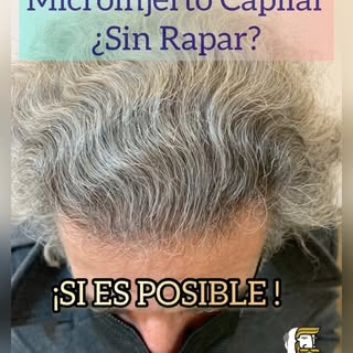 Microinjerto Capilar Tecnica FUE + DHI SIN RAPAR Resultado a los 15 meses. 2560 Grafts (4399 folícul