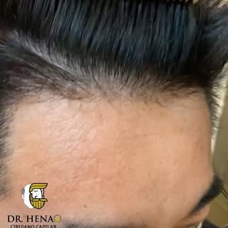 Microinjerto Capilar Tecnica FUE + DHI, Alta Densidad. Resultado a los 12 meses. 2770 Grafts (6033 f