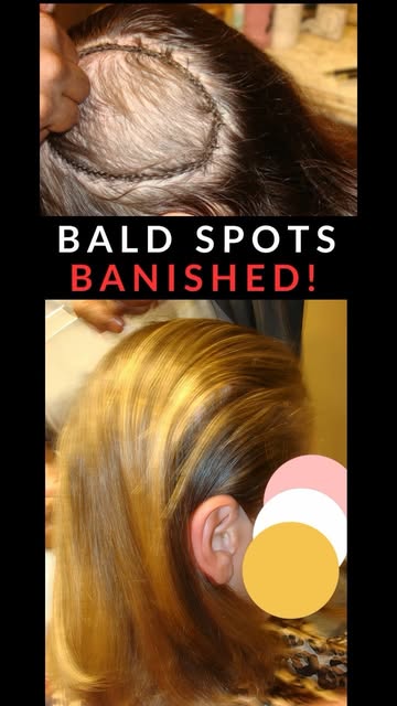 POV: When covering a #baldspot is both a #hairlosstransformation and #mentalhealthsupport. 

“I bega