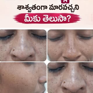 Do you have spots like these on your face? If so, this video is just for you.

To book an appointmen