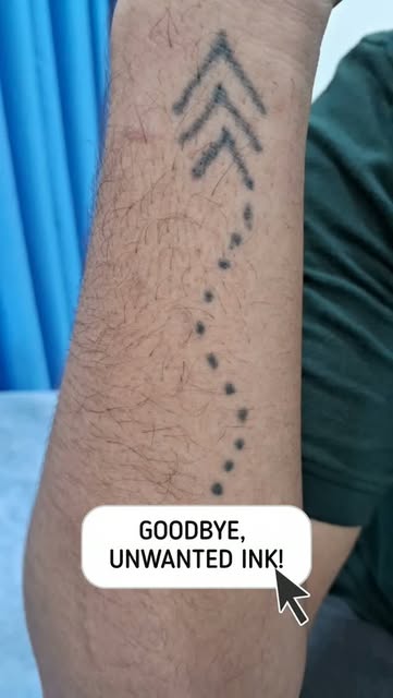 Ready to Let Go of That Tattoo? ✨
Unwanted tattoo? Modern Laser Tattoo Removal can help fade tattoo 