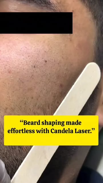 Beard game on point with Candela Laser 

To book an appointment with our dermatologist contact us at