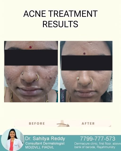 Real results. Real skin transformation. ✨

Acne can affect more than just your skin — but with the r