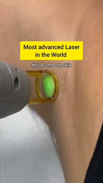 Candela Laser is here to give you the most advanced and best results for Laser Hair Removal.

⏩Most 