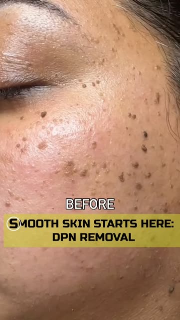 Those tiny dark bumps on your skin could be DPNs (Dermatosis Papulosa Nigra) — a common and harmless