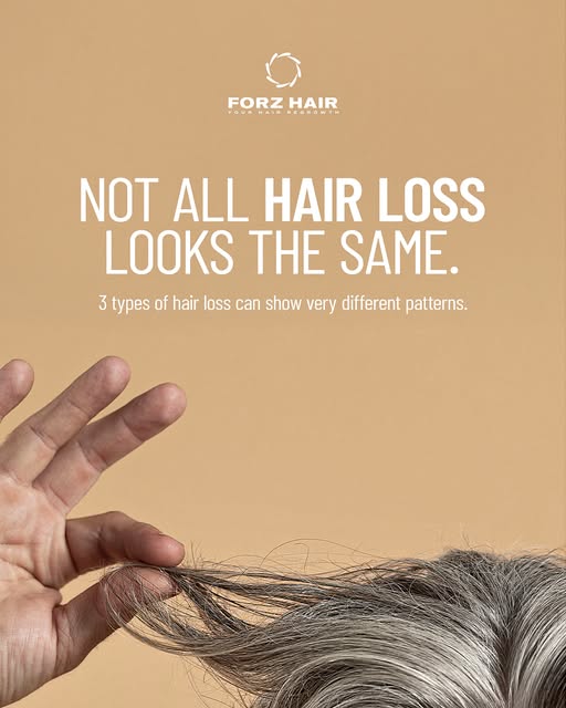 Hair loss does not always follow the same pattern.

Androgenetic alopecia typically develops gradual