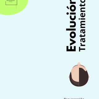 Recuperación Alopecia Andrógena Masculina. 

Paciente con data de pérdida aproximados 10 años. 
Se d