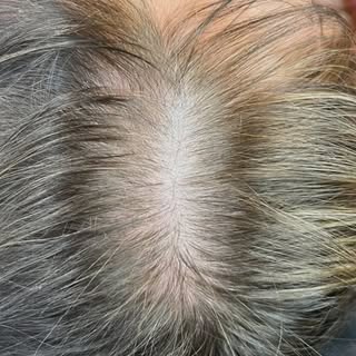 🚨SMP🚨 This is a game changer. No longer do we have to deal with thinning or sparse hair. Great for