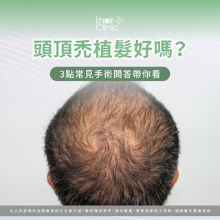 頭頂越來越透光，植髮真的適合嗎？
-
照鏡子時不明顯，卻總在燈光下或照片中
看見頭頂髮量稀疏、空洞越來越清楚？
考慮頭頂植髮前，許多髮友都有這些疑問：
🔹 後枕部毛髮移植到頭頂，會不會看起來不自然？