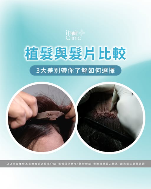 植髮VS髮片怎麼選？3大關鍵差異，讓你告別禿頭超有感！
-
面對落髮問題，你還在猶豫該選植髮還是髮片嗎？🤔
雖然兩者都能改善外觀
但在「效果持久度、外觀真實度、日常便利性」上，卻有大有不同
髮片能立