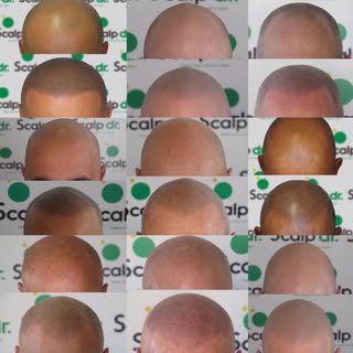 It’s amazing what SMP can do for one’s confidence! A good hairline takes years off your look. We’re 