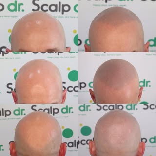 A great natural result for a very cool client, what a difference a good hairline can make.

Scalp Mi