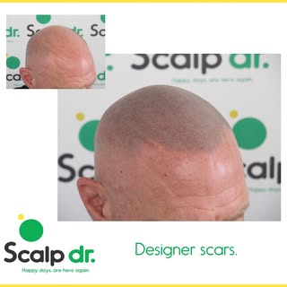 I love a little designer scar, I also like to leave scars within the treatment if they work. I have 
