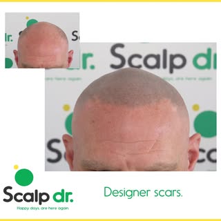 Front view of the designer scar on the LHS and enhanced natural scars on the 
RHS.

Looks natural to
