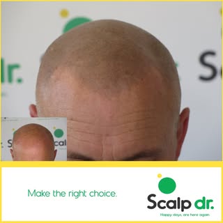 Always keeping it subtle and natural!

https://www.scalpdr.co.za

Call us at Scalp Dr. Cape Town on 