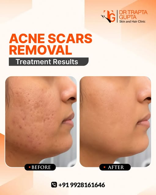 ✨ Acne Scars, Better Skin Starts Here. ✨

Acne scars can affect more than just your skin — they can 