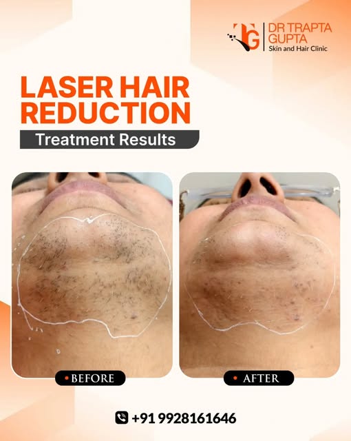 ✨ Smoother-looking skin starts with the right approach. ✨

This Laser Hair Reduction treatment is de