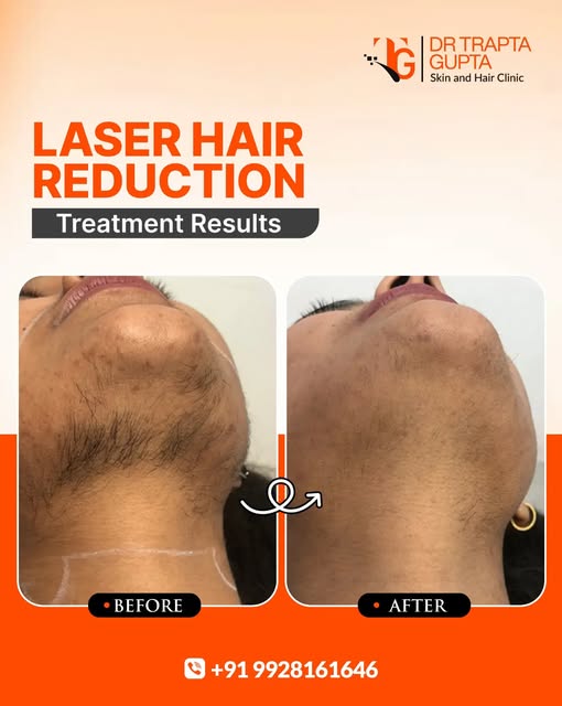 ✨ Laser Hair Reduction — Visible Treatment Results ✨

A closer look at the improvement that can be s