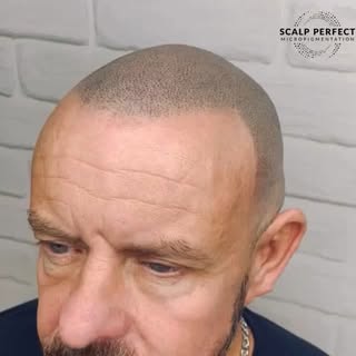 Natural. Undetectable. Confidence Restored.

Struggling with thinning hair or a receding hairline? S
