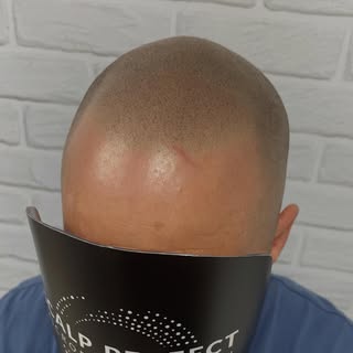 First session complete and already looking mint! Message to book your free consultation  #smp #scalp