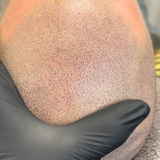 Nice n easy does it! Keeping that natural vibe going.

#smp #scalpmicropigmentation #scalpperfect #s