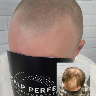 It’s just what we do 👌🏻

#smp #scalp #scalphealth #scalpmicropigmentation scalpperfect