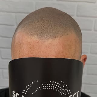 Yet another great result!!

#smp #scalp #scalphealth #scalpperfect #scalpmicropigmentationuk