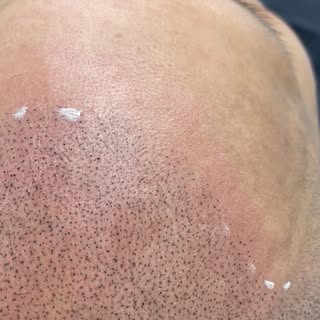 First session in and looking super natural  #smp #scalpmicropigmentation #scalp #scalpuk