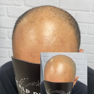First session in the bag, changing lives on a Saturday! 💪🏻 #smp #scalpmicropigmentation #scalp #sc