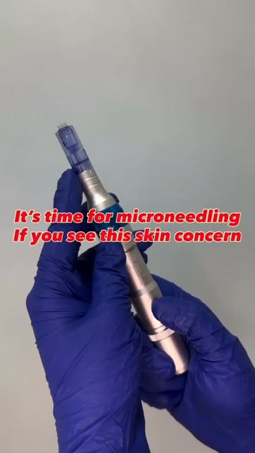 ✨ Microneedling Magic ✨
A journey towards smoother, brighter & healthier-looking skin 💫

🧴 Stimula