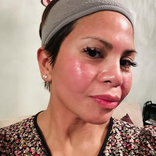 Self-care Friday day with my favorite treatment!Skinpen microneedling with exosomes! For rejuvenated