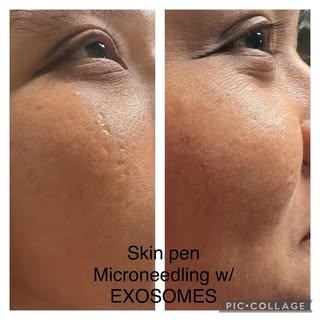 The power of EXOSOMES! The next big thing in skin care. Acne scars gone after just one treatment wit