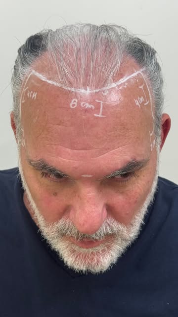 Mais do que transformar o cabelo, o transplante capilar pode representar a recuperação da confiança 