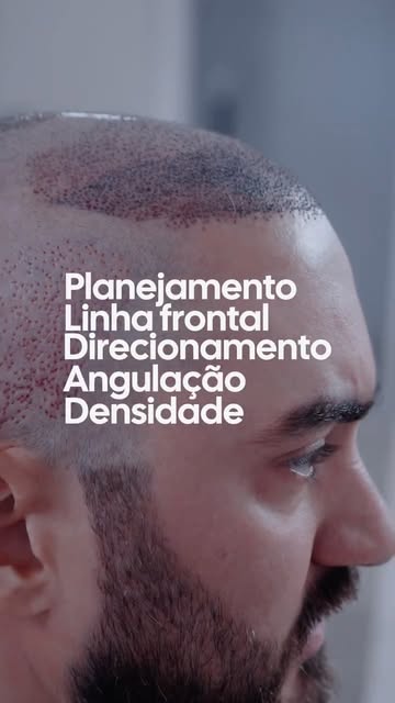 Talvez você não tenha feito ainda o Transplante Capilar, por causa disso!