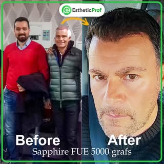 Unveiling the magic of hair transplant on this Transformation Tuesday! Our medical team at EstheticP