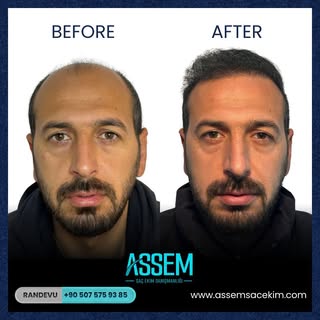 Assem Saç Ekim Danışmanlığı olarak, en son teknolojiler ve uzman ekibimizle doğal ve kalıcı saç ekim