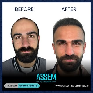 Assem Saç Ekim Danışmanlığı olarak, en son teknolojiler ve uzman ekibimizle doğal ve kalıcı saç ekim
