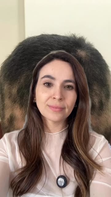 ✨Alopecia Areata

Uma doença autoimune que provoca a queda de cabelo.
O sintoma/sinal é apenas a que