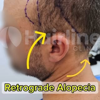 This patient has male pattern baldness with retrograde alopecia, which causes thinning above the ear