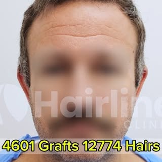 This patient has been using hair loss prevention medications for over 15 years but noticed a slow pr