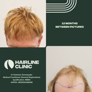 12 months post procedure, 6300+ Grafts 2 days @hairlineclinic.au 

Dr Rukshan Senanayake
Medical Pra