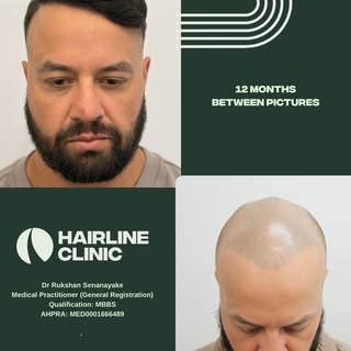 12 months post hair transplant - 9487 Grafts 

Scalp & beard grafts used to maximise density across 