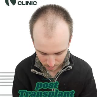 One year post hair transplant w @dr_ruk 

Dr Rukshan Senanayake
Medical Practitioner (General Regist