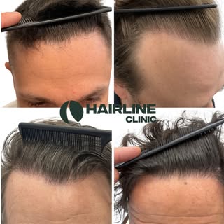 Hairline design is everything.

It is the difference between a result that looks natural and one tha