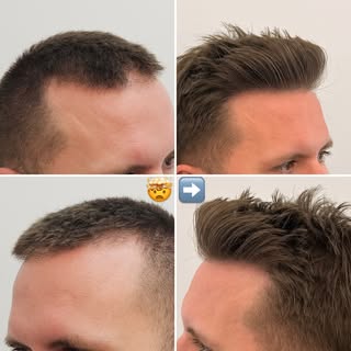 3,573 grafts. 9,325 hairs. 

One incredible transformation.
Dr. Ruk restored the hairline and crown 