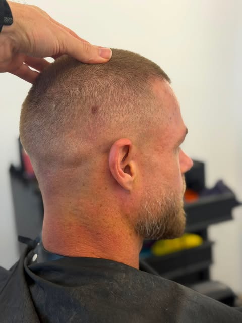 3,375 grafts — 12 months post-op with a zero fade.

When considering a hair transplant, donor manage