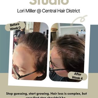 INTRODUCING! Hair Loss Systems | Saskatoon
​
At Central Hair District we focus on scalp health and f