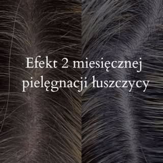Łuszczyca ☝🏻 

Choroba, która może objawiać się zmianami zapalnymi na całym ciele lub jak w tym prz