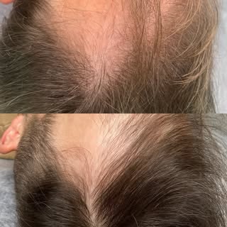 Terapia w łysieniu androgenowym 👆🏻 

Efekt zastosowania suplementacji blokującej postępujące łysie